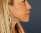 Feel Beautiful - Necklift 206 - After Photo